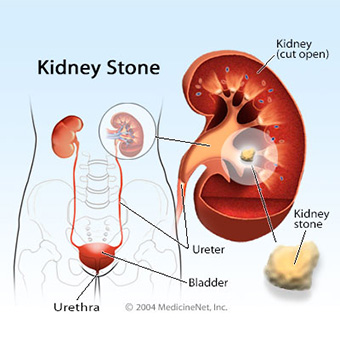 kidney-stones-s2-illustration